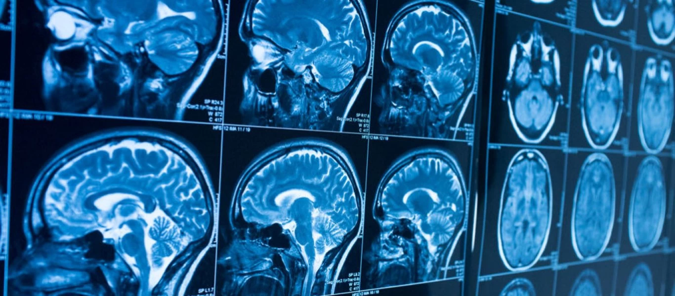 Θεράπευσαν αλκοολικό με εγχείριση στον εγκέφαλο - Του εμφύτευσαν καλώδια (βίντεο)